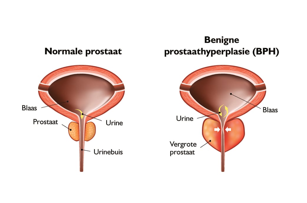 Prostate image NL