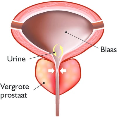 Benigne prostaathyperplasie (BPH)